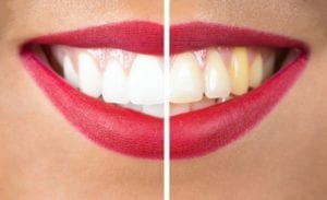 cosmetic dentistry in peachtree city, georgia